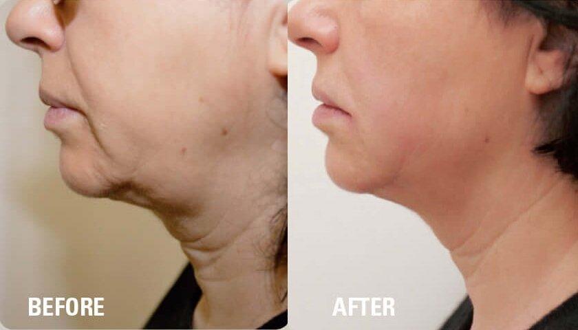 HIFU facial treatment before-after-1