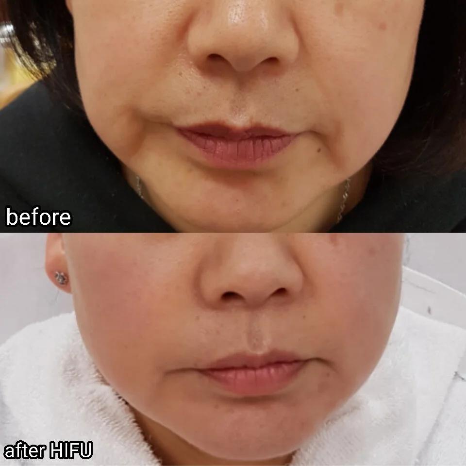 HIFU facial treatment before-after-2