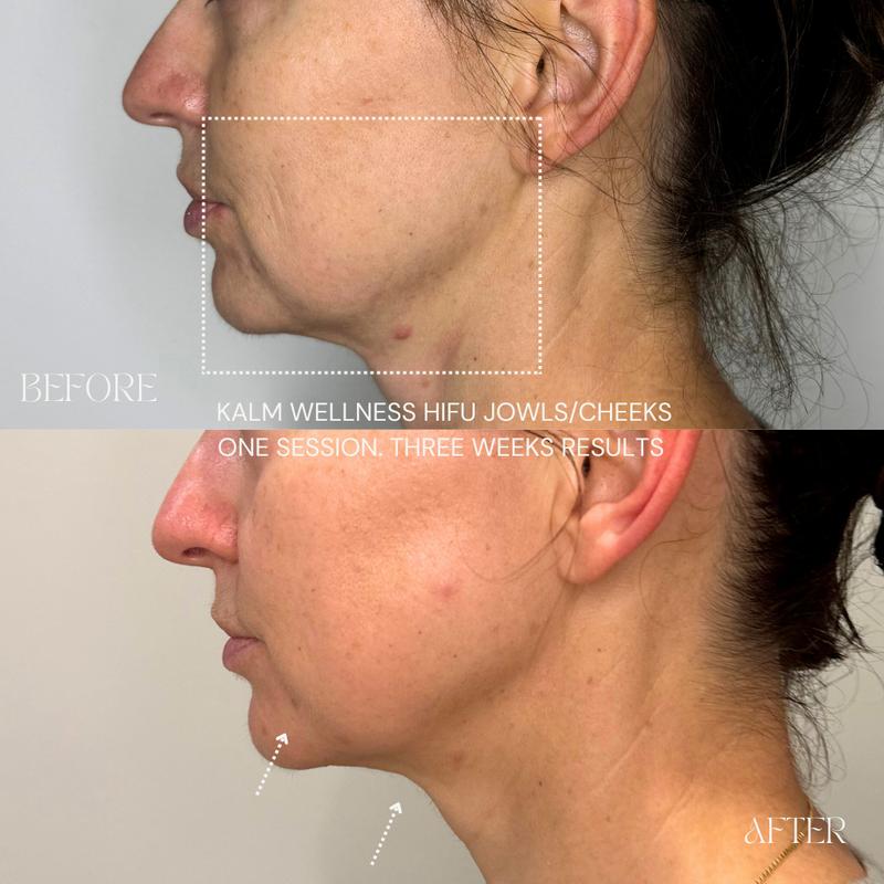 HIFU focused ultrasound energy targeting deeper skin layers
